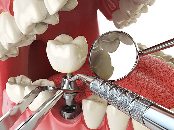 Best Emergency Treatment for Dental Infections or Abscesses in Bridgeview, IL